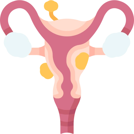 Útero con Endometriosis